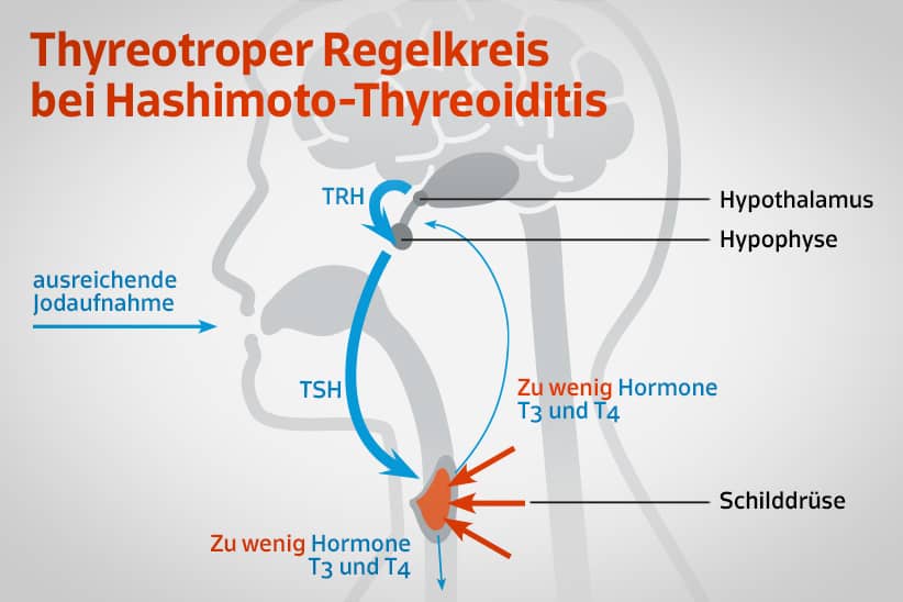 Hormonexpert Schilddrüse Hashimoto Thyreoiditis Grafik